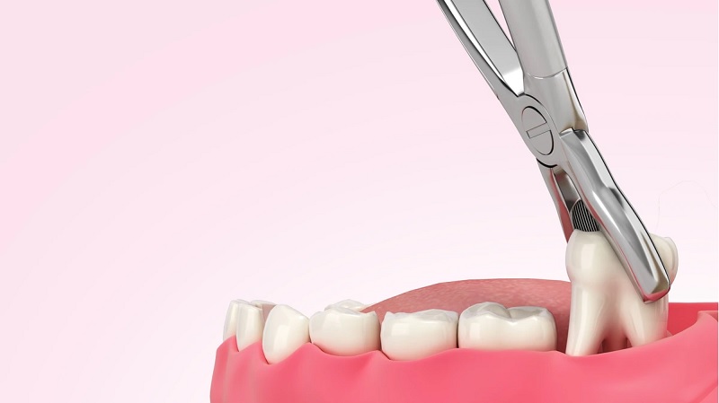 Vết khâu nhổ răng khôn bị hở: Nguyên nhân, biểu hiện, cách điều trị