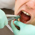 Có nên giữ lại răng sau khi nhổ? 