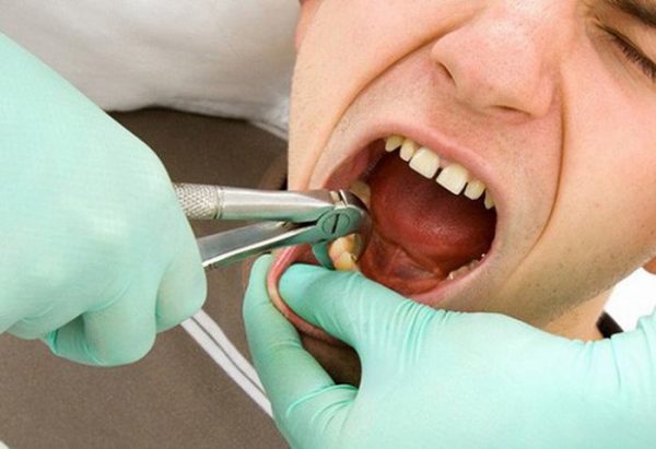Vỡ cục máu đông sau khi nhổ răng có sao không?