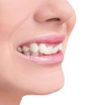 Tình trạng sức khỏe răng loại 2: Bạn đã hiểu đúng mức độ nghiêm trọng?