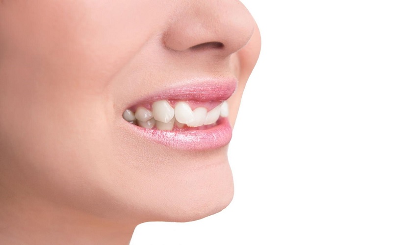 Răng nanh mọc lệch: Nguyên nhân, tác hại và cách khắc phục