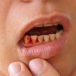 Nhổ răng xong ăn cay được không?