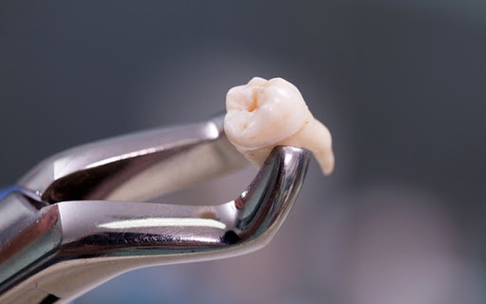Nguyên nhân nhổ răng số 8 không cầm được máu