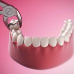 Ổ răng sau nhổ có mùi hôi – Có đáng lo không?