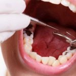Nuốt máu răng có sao không?