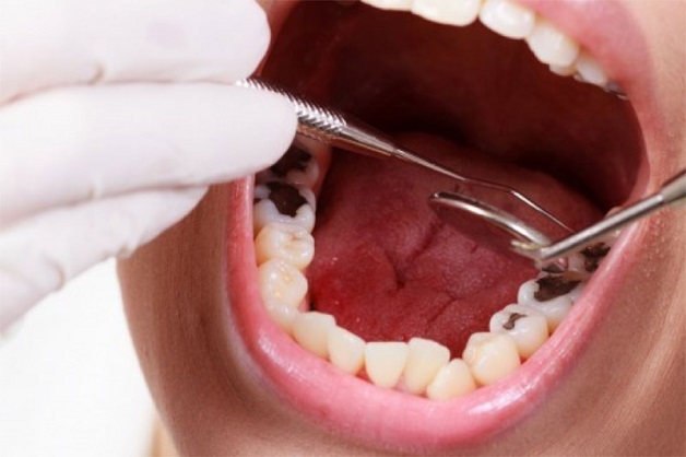 Nhổ răng xong ăn cay được không?