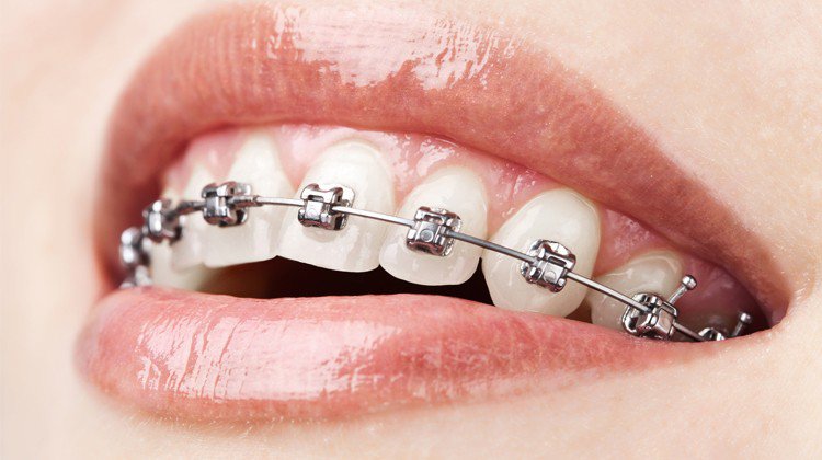 Niềng 4 Răng Cửa Có Hiệu Quả Không? Chi Phí Thế Nào?