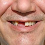 48 Tuổi Bị Rụng Răng Là Do Đâu?