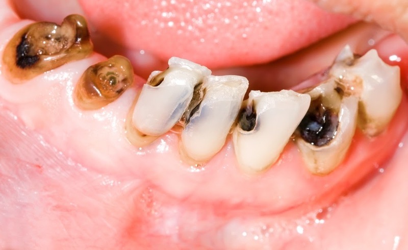 Đa sâu răng ở trẻ em: Nguyên nhân, triệu chứng và cách điều trị
