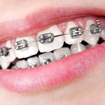 Địa chỉ làm răng thẩm mỹ uy tín ở Hà Nội