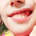 Đa sâu răng ở trẻ em: Những điều cha mẹ cần biết để can thiệp kịp thời