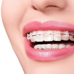 Review Kinh Nghiệm Nhổ Răng Khôn Thực Tế & Lưu Ý Quan Trọng