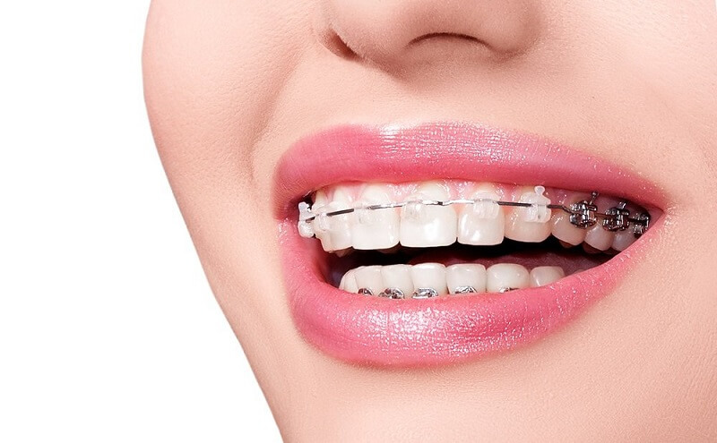 GIÁ NIỀNG RĂNG TRẢ GÓP TẠI HÀ NỘI