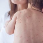 Nguyên nhân gây Lợi trùm răng cửa và hướng khắc phục hiệu quả