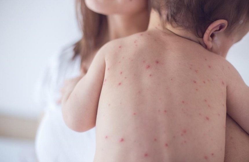 Trẻ sốt mọc răng xong phát ban: Nguyên nhân và cách khắc phục tại nhà