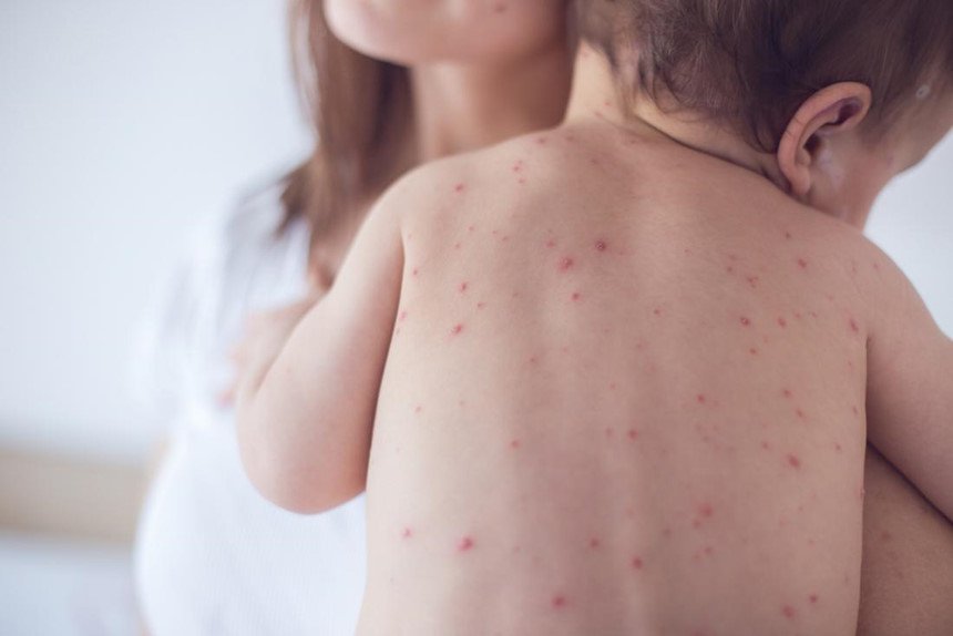 Trẻ sốt mọc răng xong phát ban: Nguyên nhân và cách khắc phục tại nhà