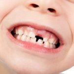 Lấy cao răng 30k có đáng tin hay không? Các điều cần lưu ý
