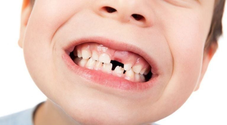 Bé thay răng cửa lâu mọc – cảnh báo từ sức khỏe răng miệng và giải pháp cần thiết