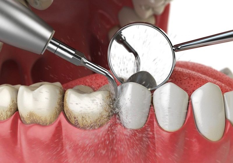 Cát sò đánh bóng răng là gì? Công dụng bất ngờ cho sức khỏe răng miệng