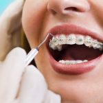 Hàm duy trì Hawley là gì? Những điều cần biết về loại hàm này