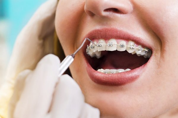 Kéo Cụm 4 Răng Cửa Mất Bao Lâu?