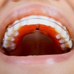 Quy Trình Điều Trị Tủy Răng Chuẩn Bộ Y Tế: Hướng Dẫn Đầy Đủ Từng Bước