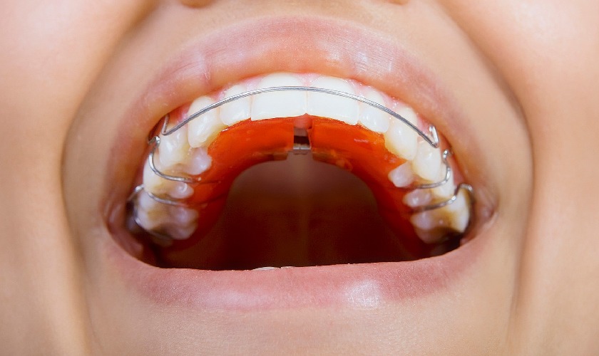 Hàm duy trì Hawley là gì? Những điều cần biết về loại hàm này