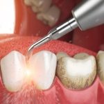 Nguyên nhân gây Lợi trùm răng cửa và hướng khắc phục hiệu quả