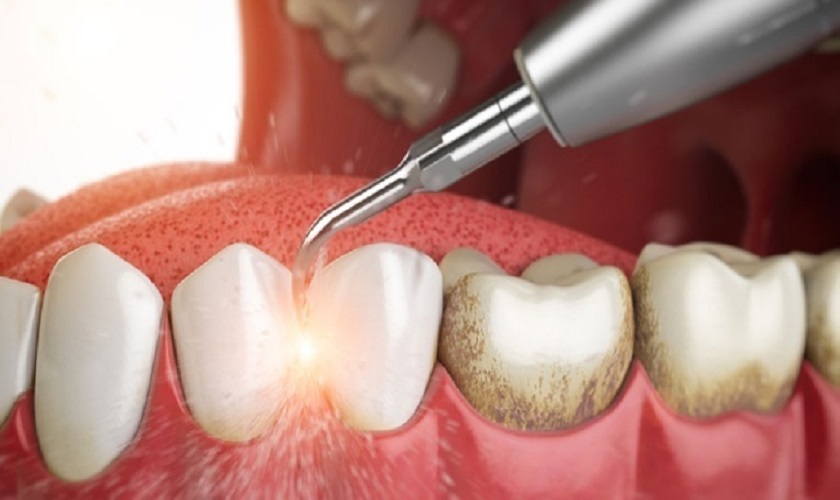 Lấy cao răng 30k có đáng tin hay không? Các điều cần lưu ý