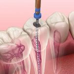 Vì sao răng hàm bị thủng lỗ to? Giải mã nguyên nhân & hướng điều trị hiệu quả