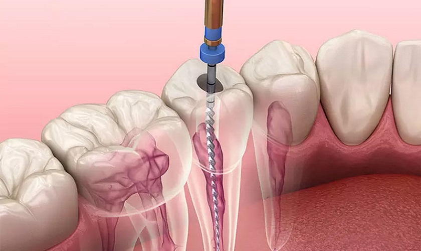 Quy Trình Điều Trị Tủy Răng Chuẩn Bộ Y Tế: Hướng Dẫn Đầy Đủ Từng Bước