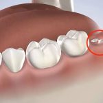Vì sao răng hàm bị thủng lỗ to? Giải mã nguyên nhân & hướng điều trị hiệu quả
