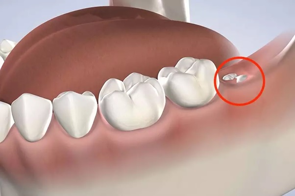 Giải pháp hiệu quả khi mọc răng khôn gây nứt lợi, viêm sưng nướu
