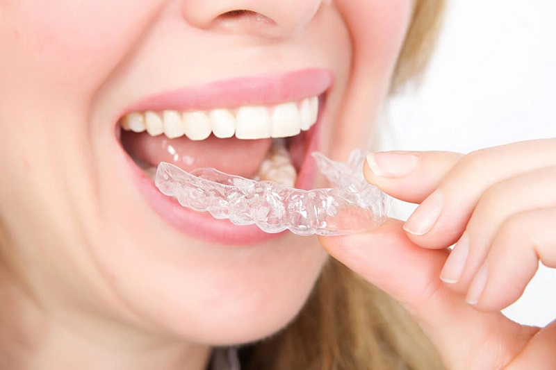 Niềng răng tháo lắp mức 1 là gì?