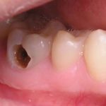 Giải pháp hiệu quả khi mọc răng khôn gây nứt lợi, viêm sưng nướu