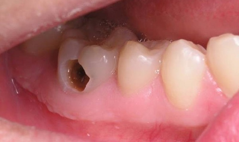 Vì sao răng hàm bị thủng lỗ to? Giải mã nguyên nhân & hướng điều trị hiệu quả