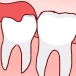 Kéo Cụm 4 Răng Cửa Mất Bao Lâu?