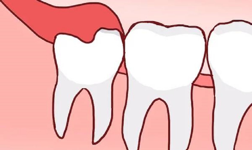 Tại sao răng khôn mọc thẳng vẫn đau?