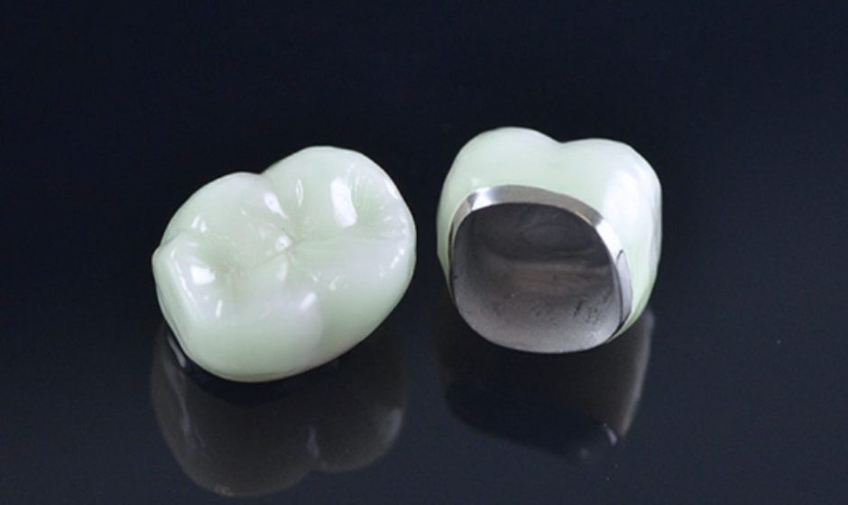 Răng sứ kim loại Ni-Cr là gì?