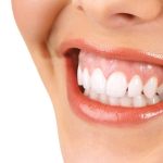 CHỈNH 1 RĂNG LỆCH GIÁ BAO NHIÊU?