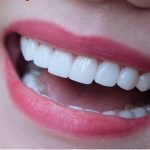 Mọc răng khôn bị sốt uống thuốc gì?
