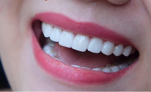 Răng bị lung lay có nên bọc sứ không?