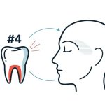 Nhổ Răng Khôn Có Bị Méo Miệng Không? Giải Đáp Chi Tiết