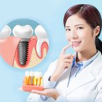 Nước súc miệng sau khi cắm Implant: Hướng dẫn chọn đúng & an toàn