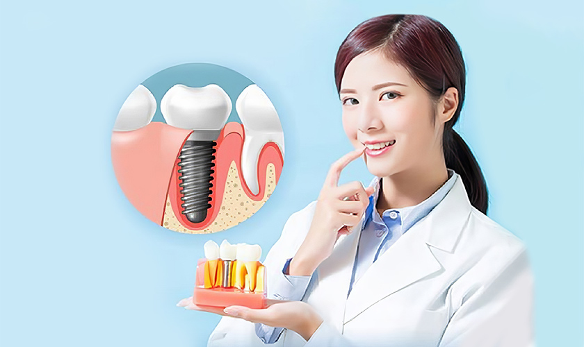 Cấy Implant Có Khắc Phục Tình Trạng Má Hóp Không? Giải Pháp Hiệu Quả!