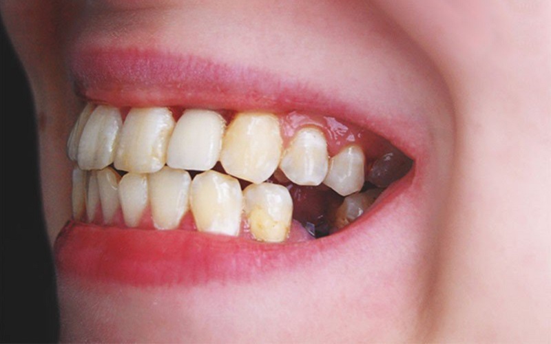 40 tuổi rụng răng phải làm sao?