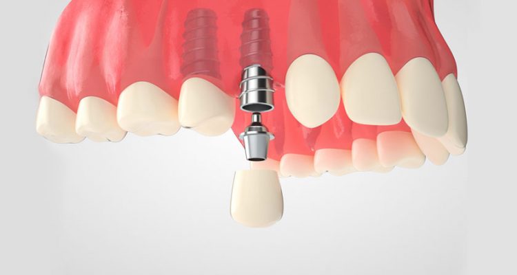Trồng răng Implant bao lâu thì ăn được cơm? Hướng dẫn chi tiết