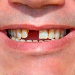 Cắm Implant Bao Lâu Thì Gắn Răng? Giải Đáp Quy Trình Chi Tiết