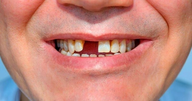 Nhổ răng cửa bao lâu thì trồng lại được? Giải đáp từ chuyên gia