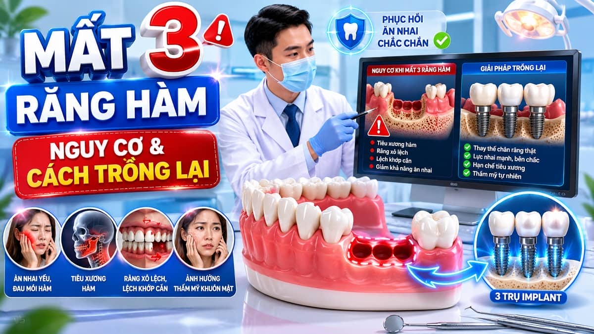 Mất 3 Răng Hàm: Nguy Cơ Và Cách Trồng Lại